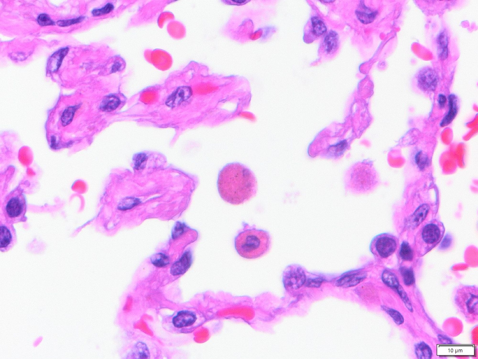 Brown pigmented macrophages in the lung. The proper lung tissue is showing signs of interstitial fibrosis.