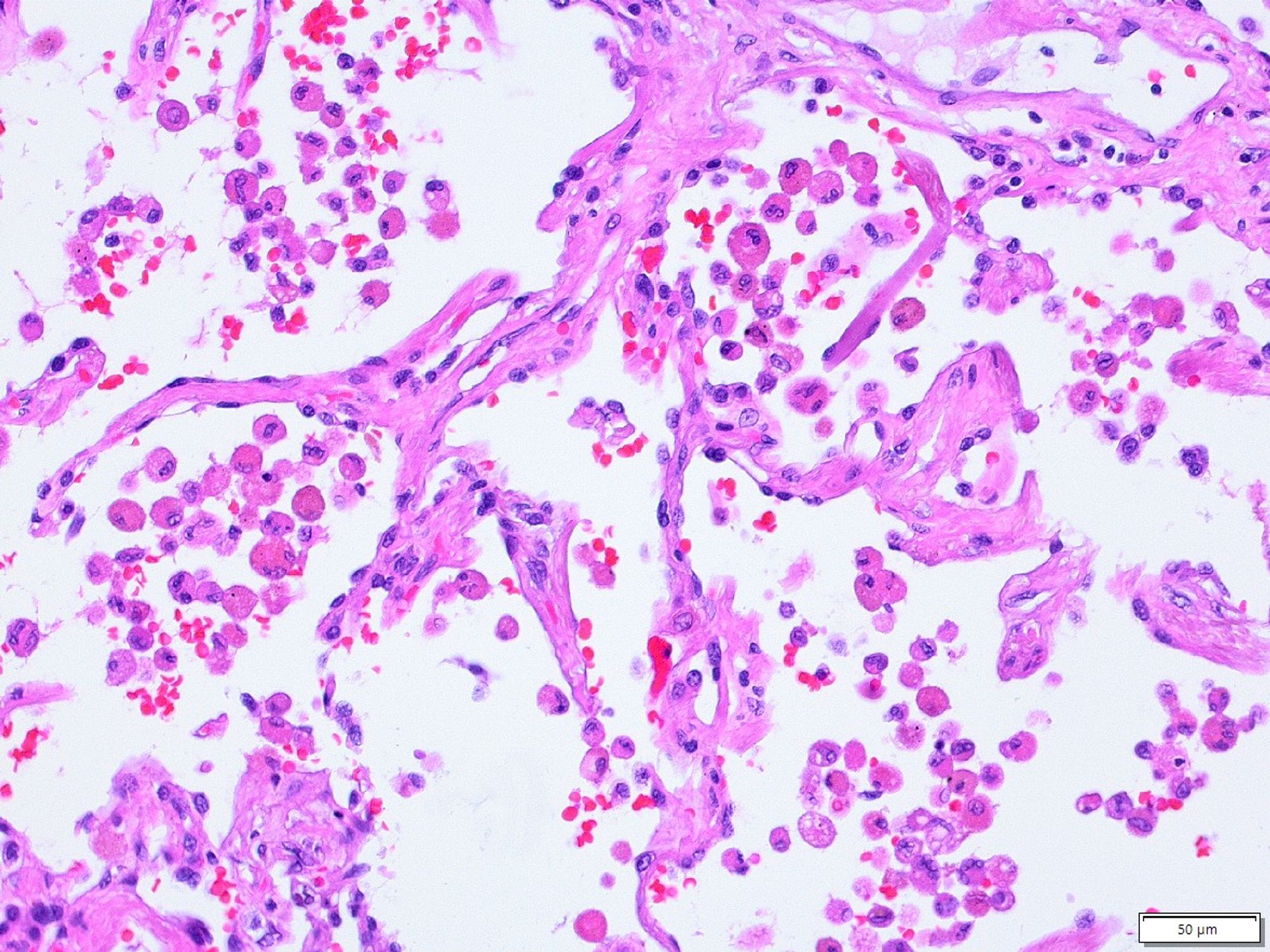 Airspaces are filled with smokers macrophages (condensate macrophages)