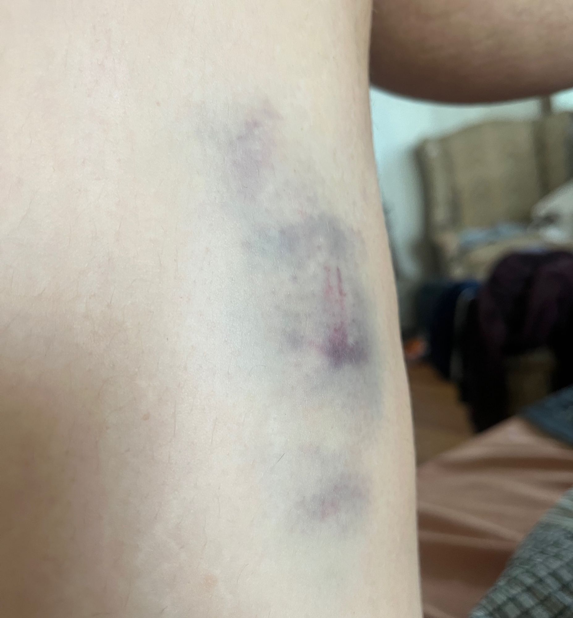 big splotchy purple and maroon bruise on my inner thigh, like the length of a palm. there's a completely straight line in there and it looks ouchy