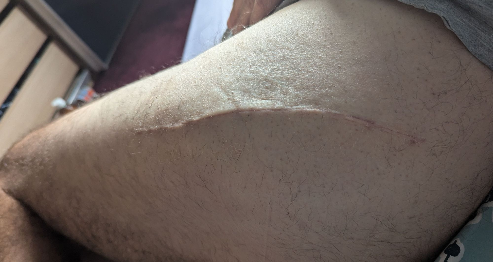 Matt's scar.knee joint on far left