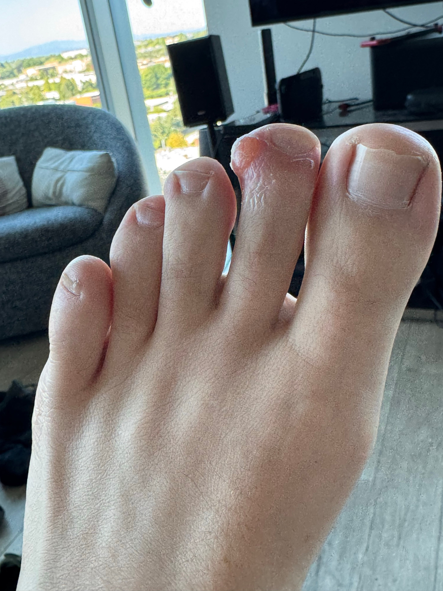 An image of my left foot with a large blister on my second toe
