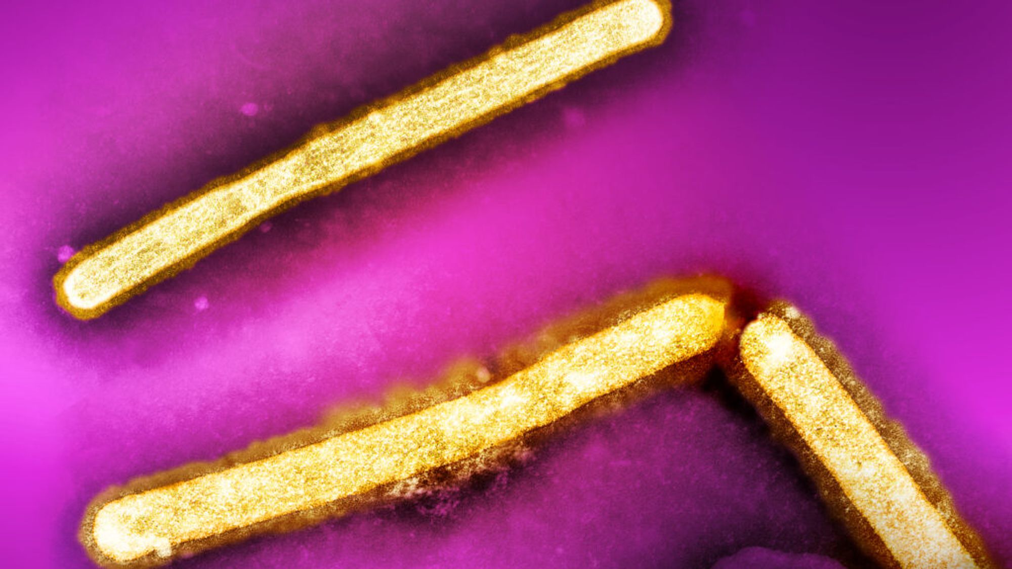 Four more health care workers reported illnesses after caring for bird flu case in Missouri