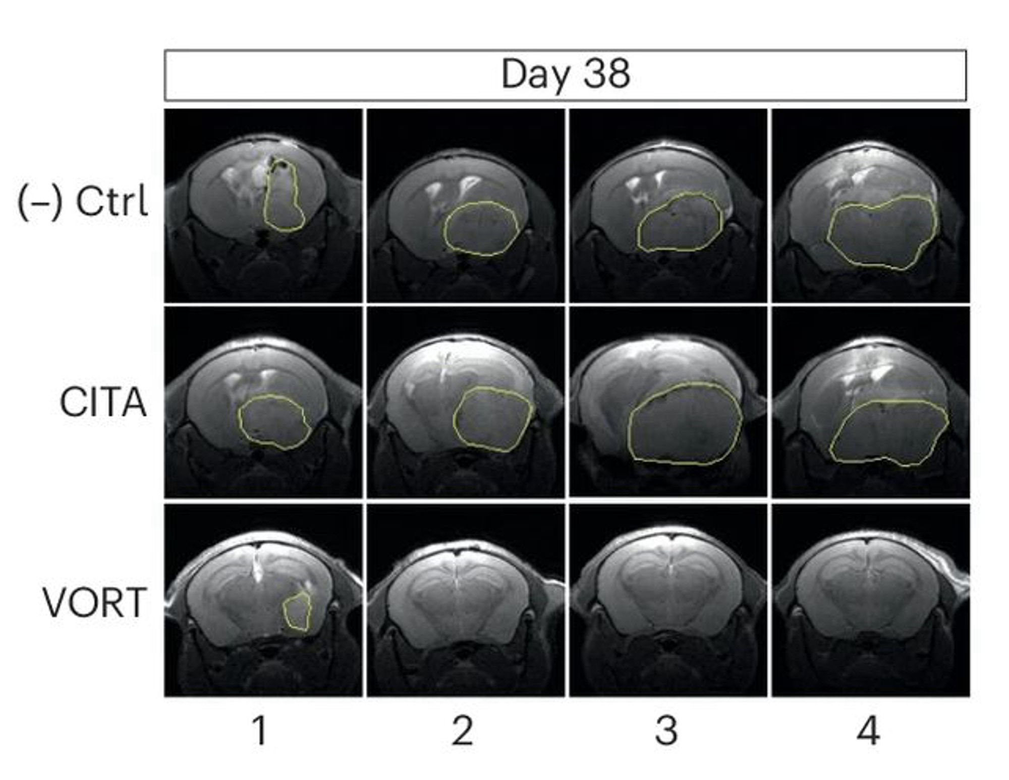 MRI scans of mouse brains from each group 38 days after tumor implantation. The top row is the control group; middle is citalopram; and the bottom is the vortioxetine group. The yellow line indicates the tumor. (Lee et al., Nat. Med., 2024)