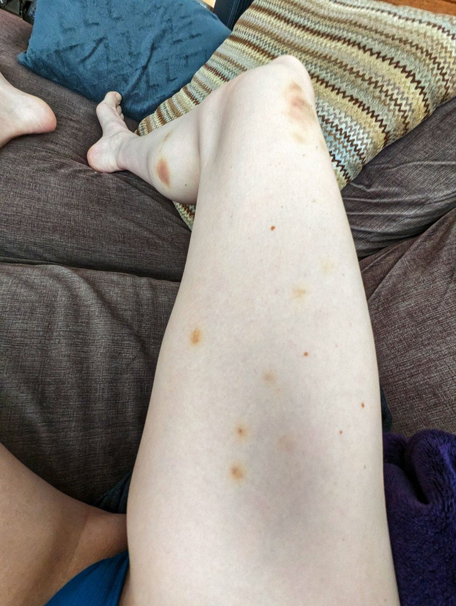 Photo of leg, two dozen little bruises (I was on all fours a lot)