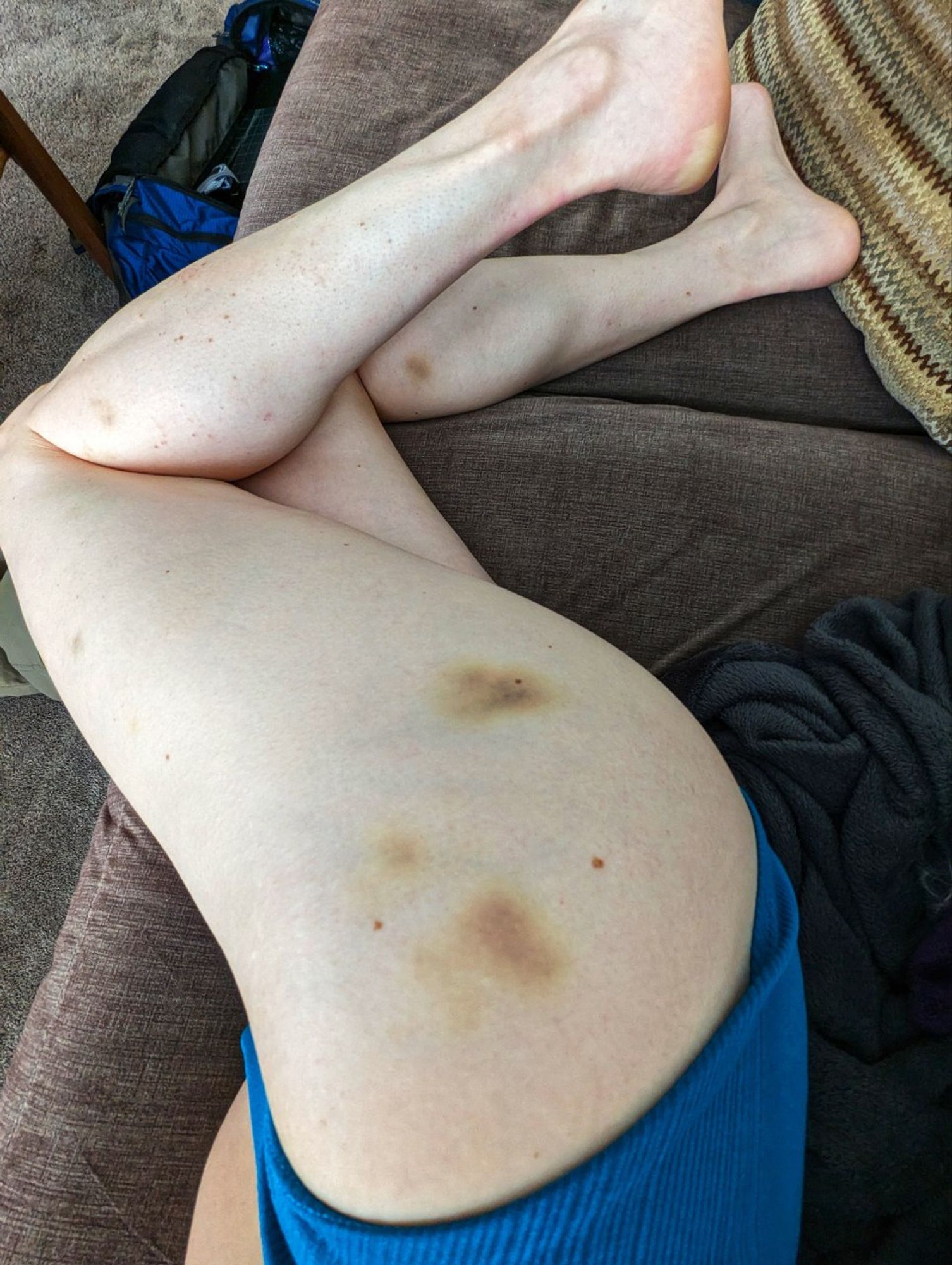 Photo of leg, two dozen little bruises (I was on all fours a lot)