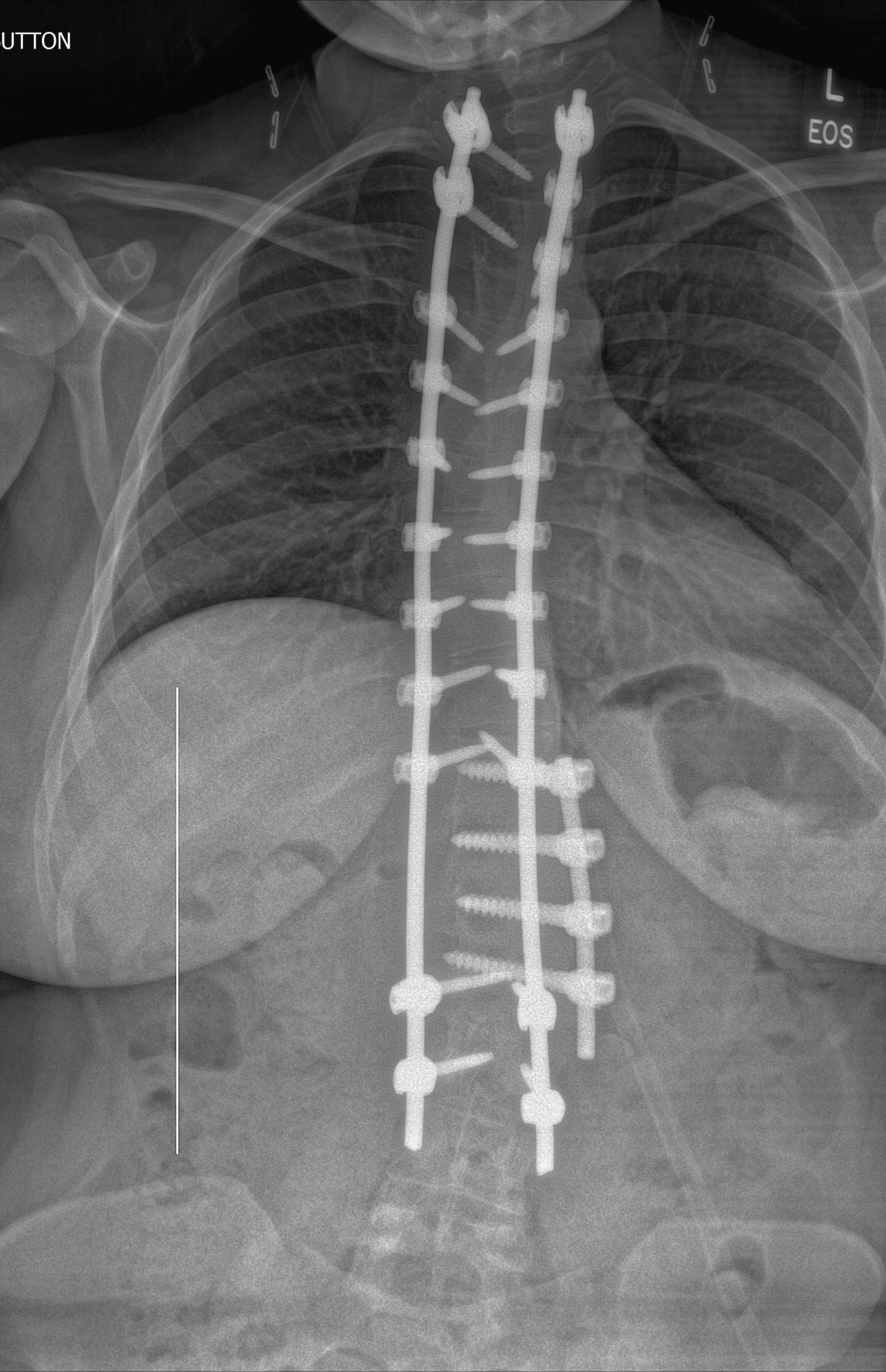 an x-ray of my spine showing a fusion from T2-L3 with two paraspinal rods and a separate fusion of t11-l2 from 2010 with a third smaller rod.
