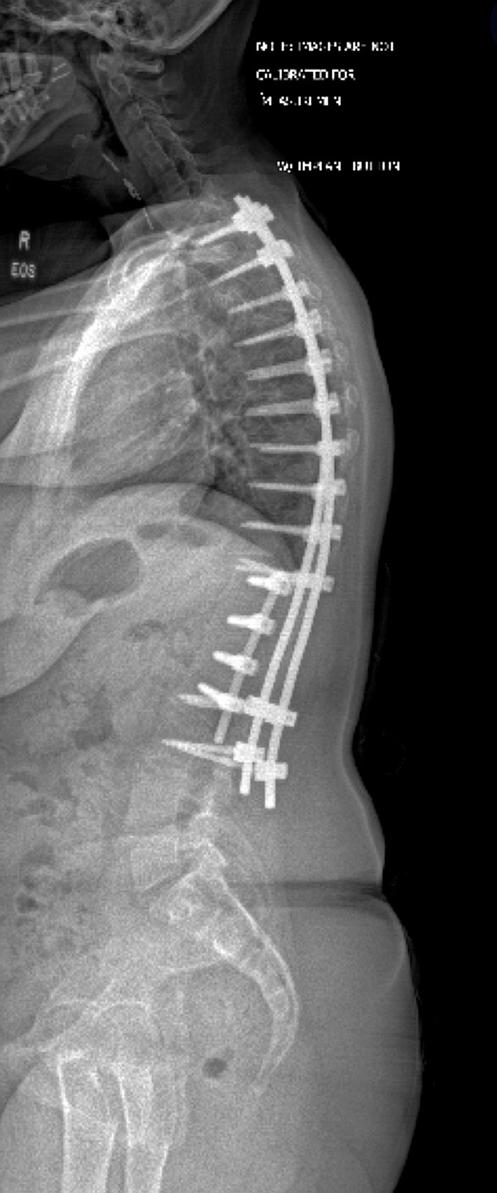 another x-ray, this time showing the side of my spine. again, there are two separate fusions (T2-L3 & t11-l2) shown with 3 separate rods and multiple large screws