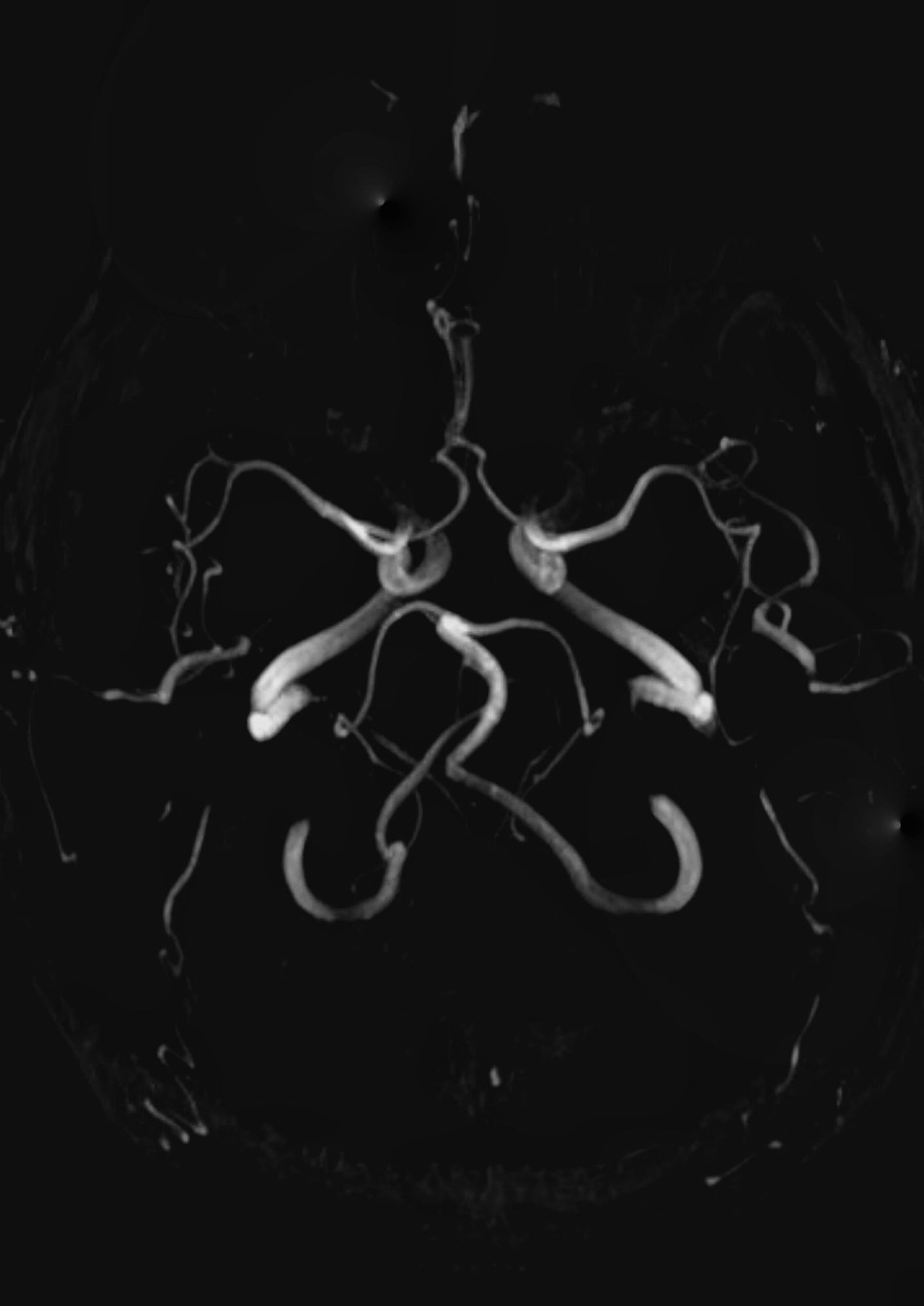 bearbeitete MRT Aufnahme vom Kopf, man sieht die Hauptgefäße, wie sie sie verwinden und ein abstraktes Gebilde darstellen, 
alles in schwarz/weiß gehalten