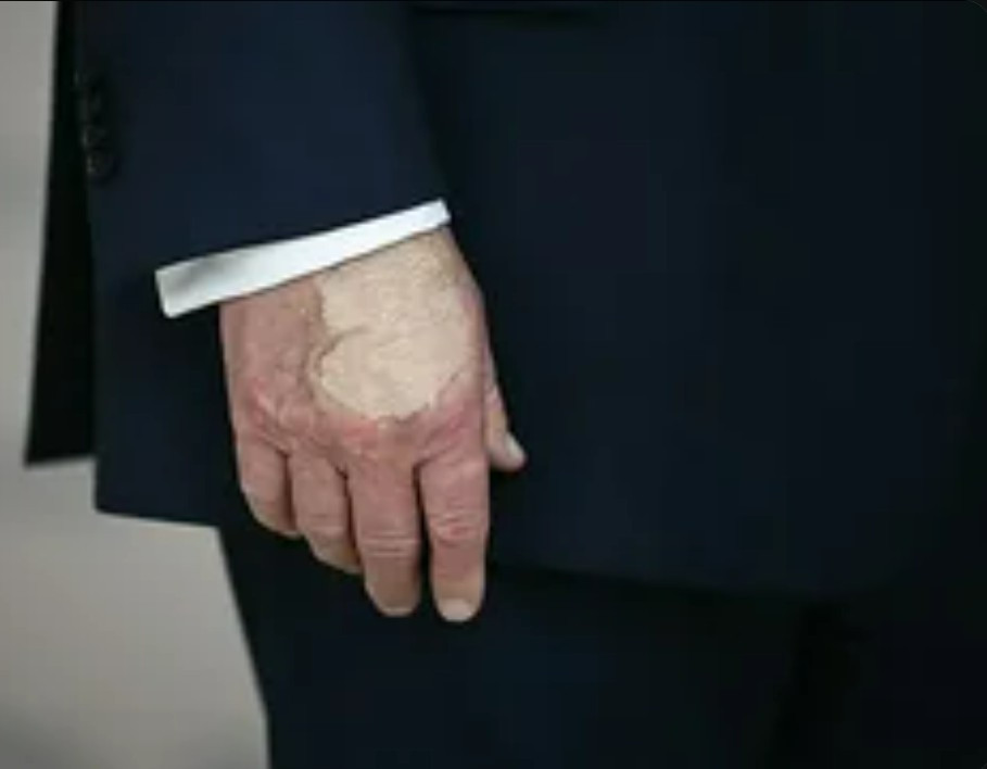 Picture of Trump's hand, heavy with makeup, probably to cover bruises he gets from medication or an IV.