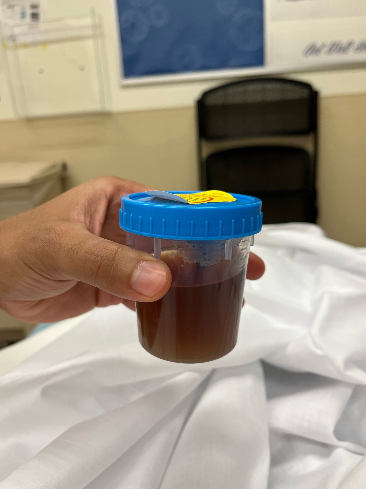 my brown pee in the hospital. it’s filled with dead blood cells. my kidneys started failing from getting clogged with so much dead blood.