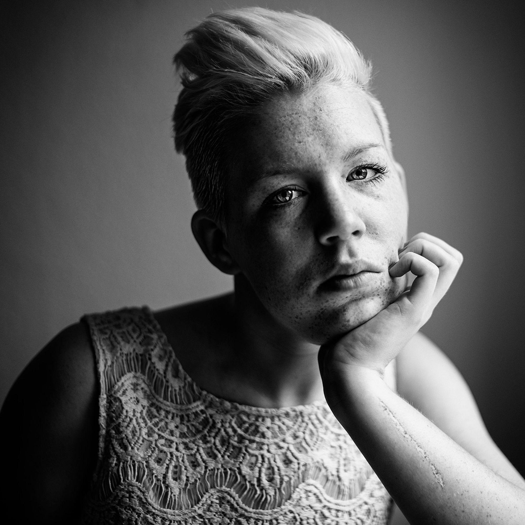 Portrait einer jungen Frau mit Sidecuts und Sommersprossen. Sie hat ihr Kinn auf die Hand gestützt, der Unterarm zeigt eine große Narbe.