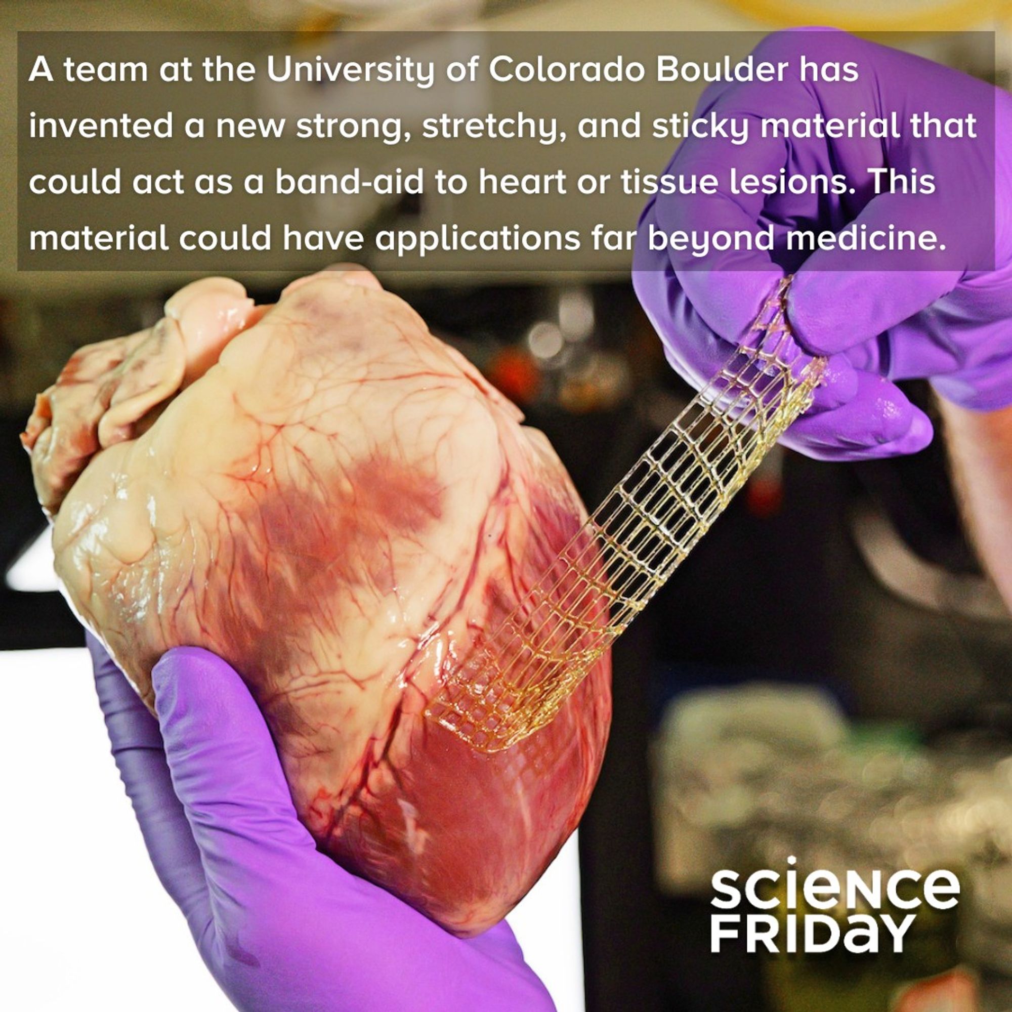 A gloved hand holding a pig heart, sticking a waffle-patterned bandage made of flexible hydrogel onto it.. A team at the University of Colorado Boulder has invented a new strong, stretchy, and sticky material that could act as a band-aid to heart or tissue lesions. This material could have applications far beyond medicine.