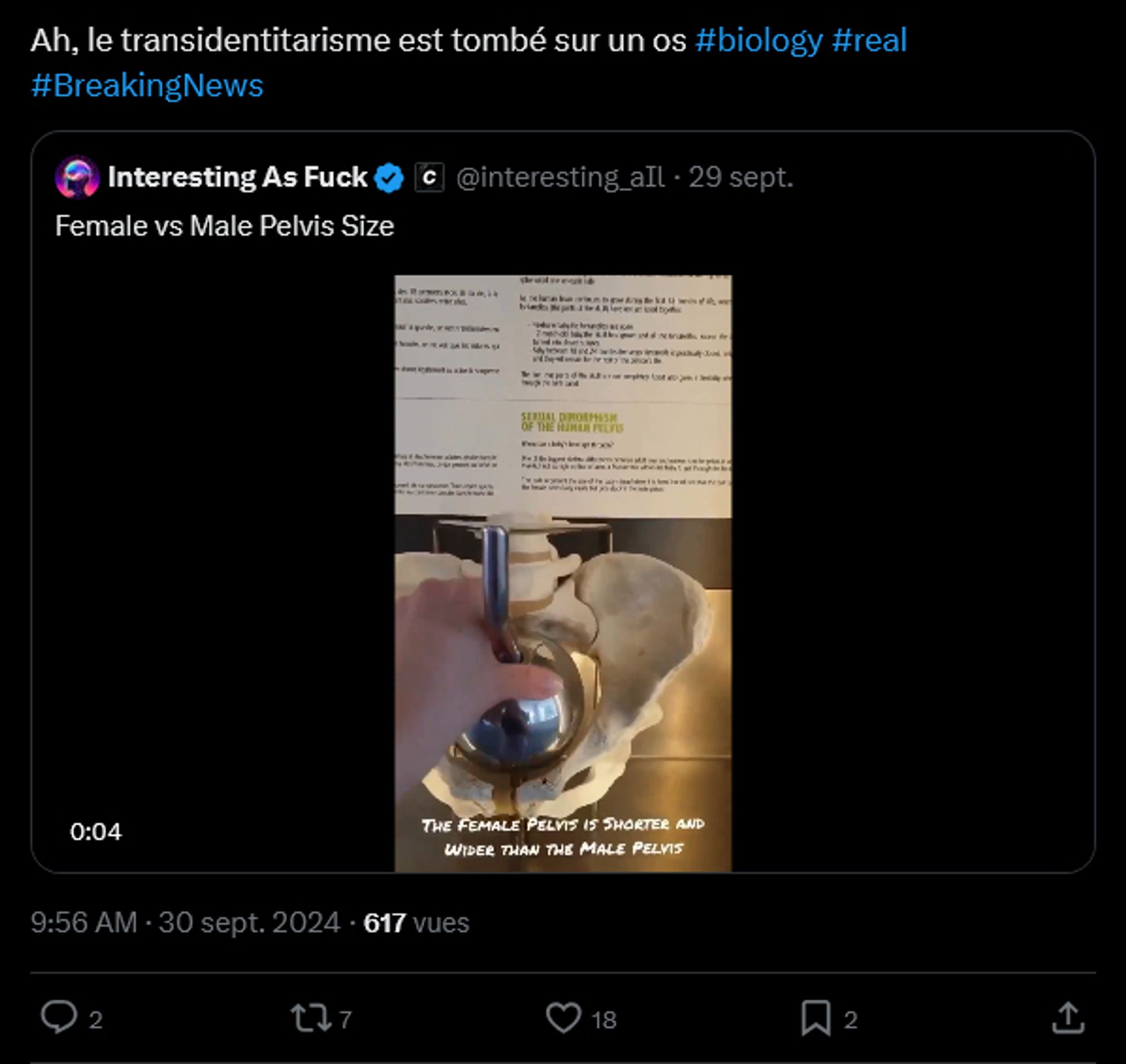 Twitter
Ah, le transidentitarisme est tombé sur un os #biology #real #BreakingNews‌

Tweet cité:
nteresting As Fuck
@interesting_aIl
Female vs Male Pelvis Size
(une vidéo où une balle en acier peut passer dans le pelvis d'une femme mais pas d'un homme)