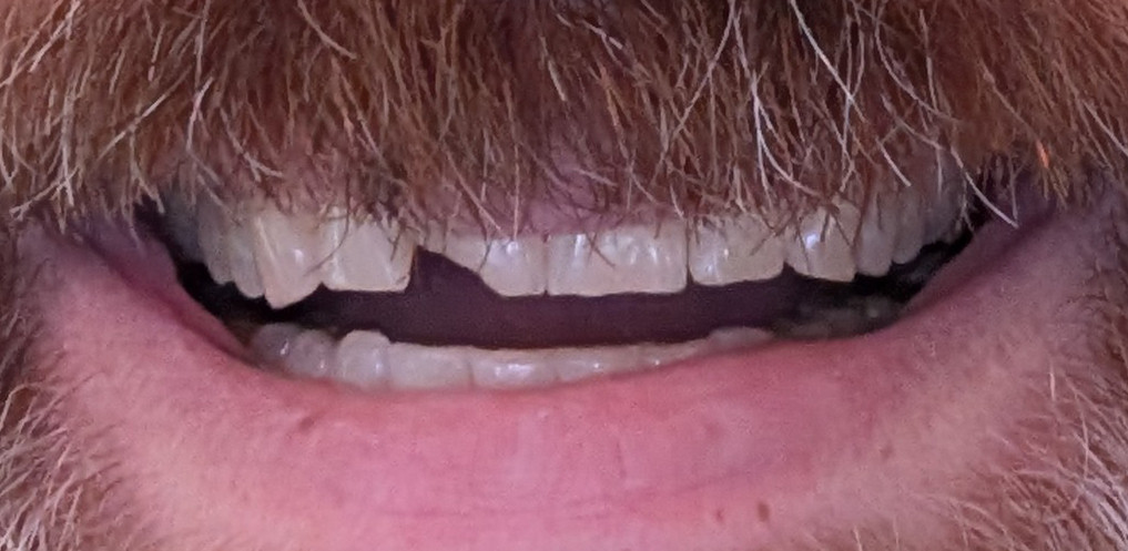 Image shows a mouth with a broken front tooth.