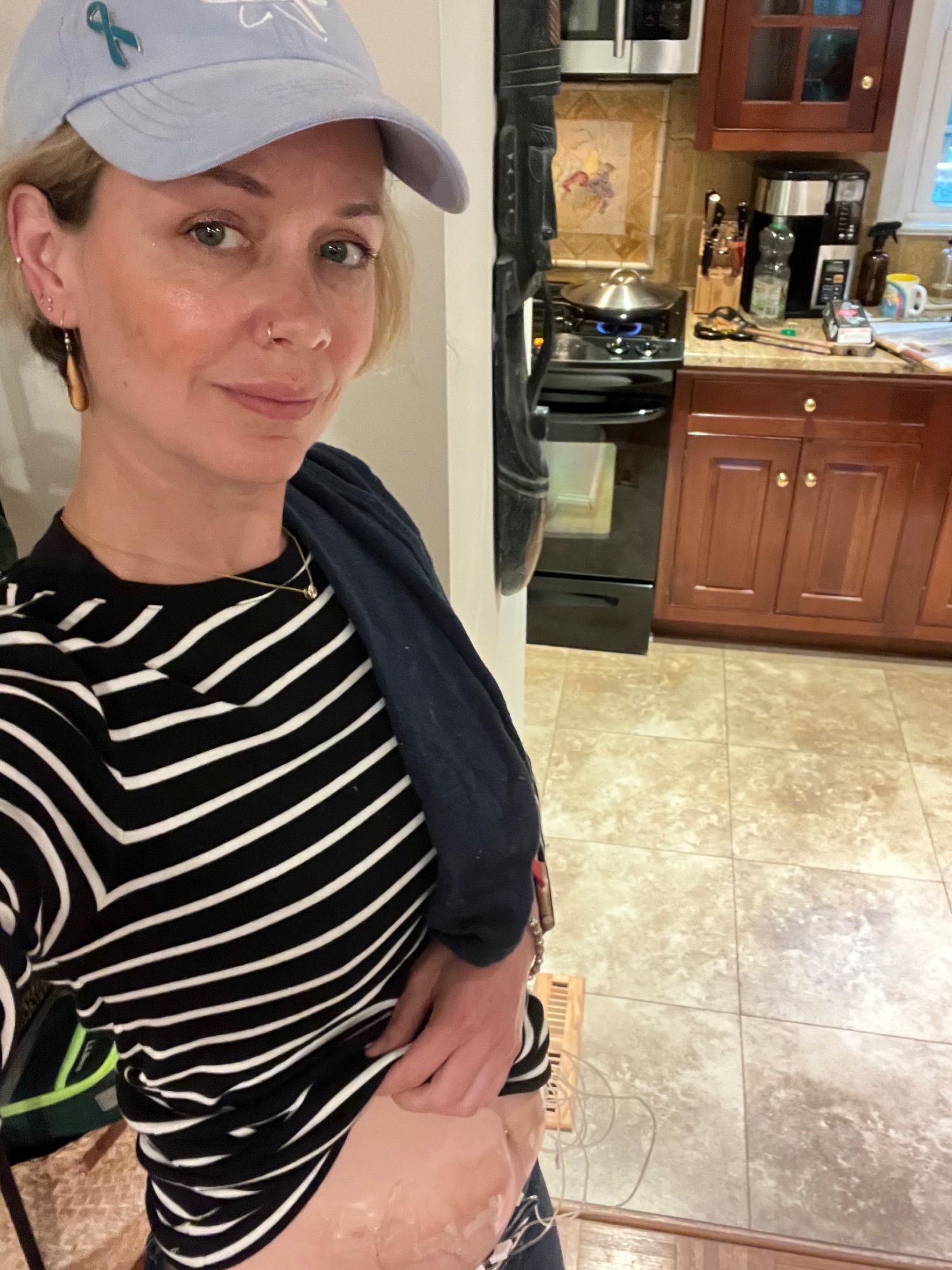 Pale-skinned woman with purple isotopes hat and turquoise #myastheniagravis ribbon wearing a black and white striped tee and showing needles in abdomen delivering life saving IG.