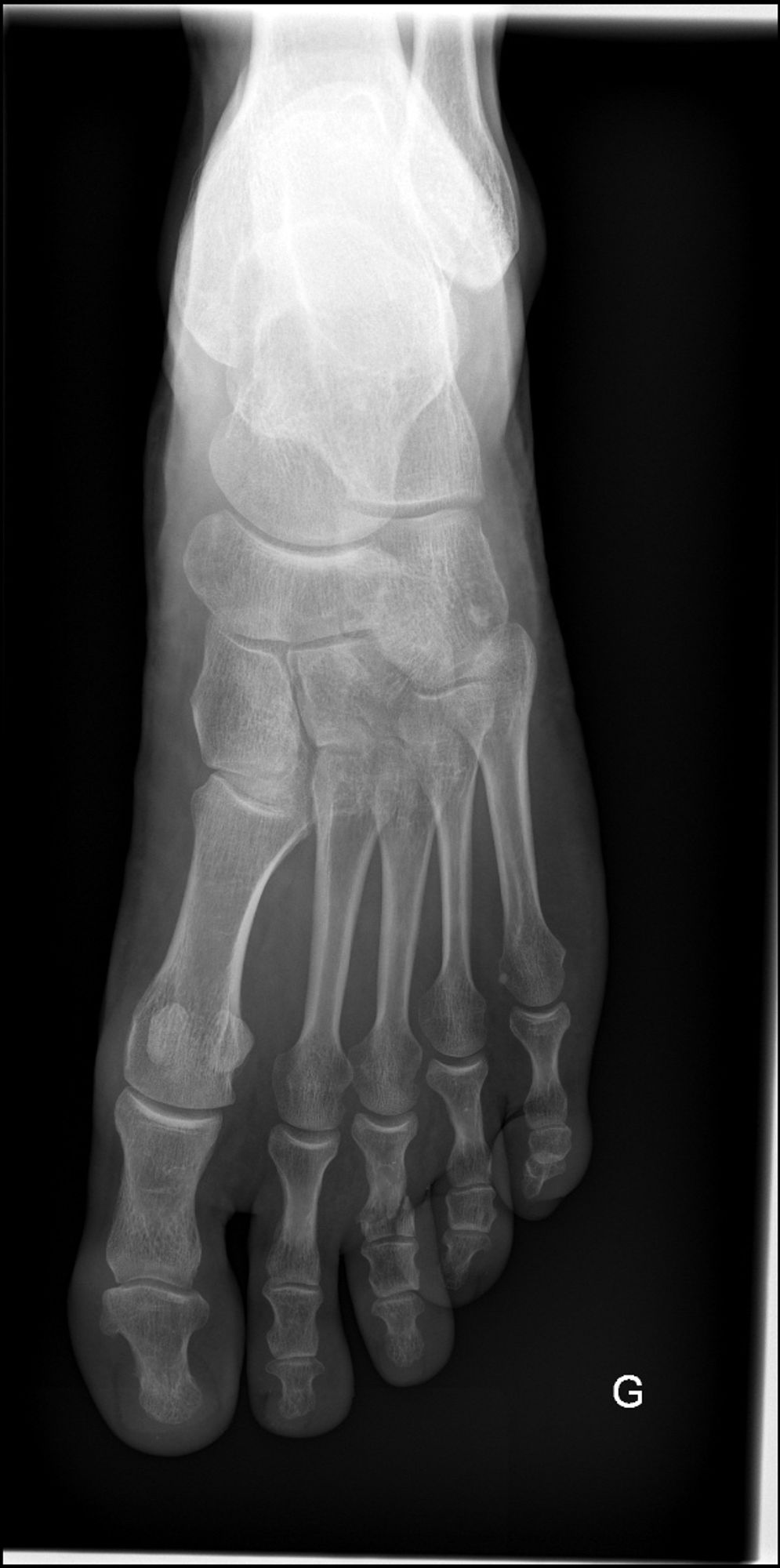 Radiographie du pied gauche avec fracture sur le troisième orteil