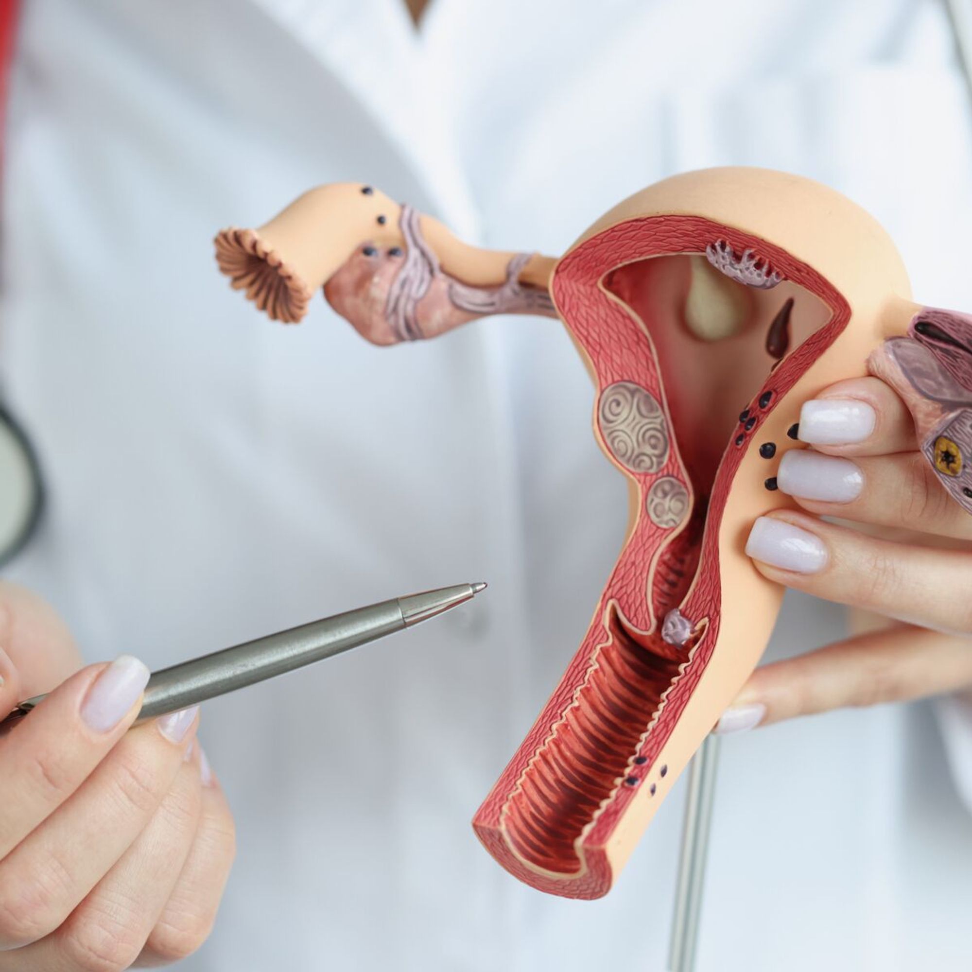 Photo de mains de femmes tenant un modèle plastique d'utérus avec différentes localisations (et formes) de cancers dessus