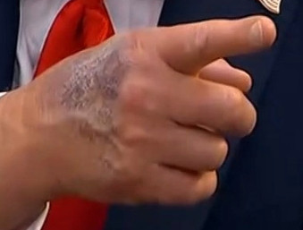 Trumpy Boo Boo has an owie on his hand. the photo clearly shows that he is underwhelming in the finger department
