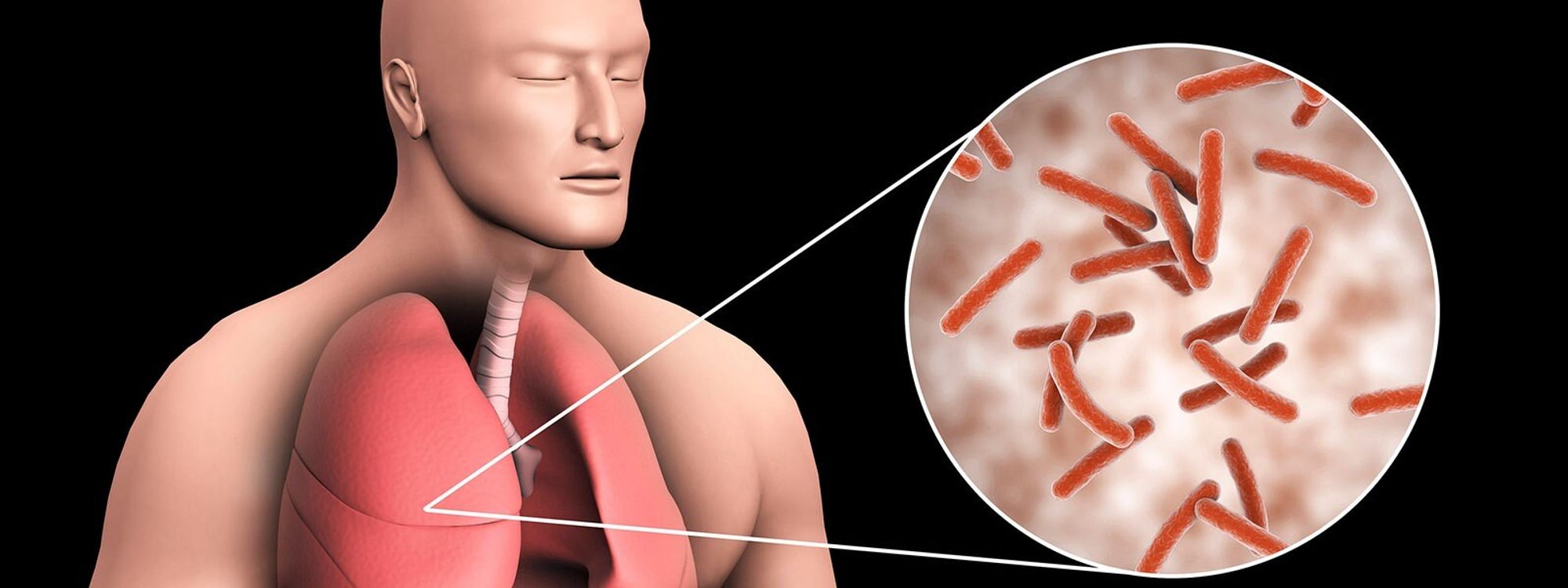  Tuberkulose wird durch Bakterien ausgelöst und äußert sich häufig als Lungenentzündung. Bildrechte: imago images/StockTrek Images 
https://www.mdr.de/wissen/tuberkulose-impfung-kandidat-besteht-phase-eins-studie-100.html