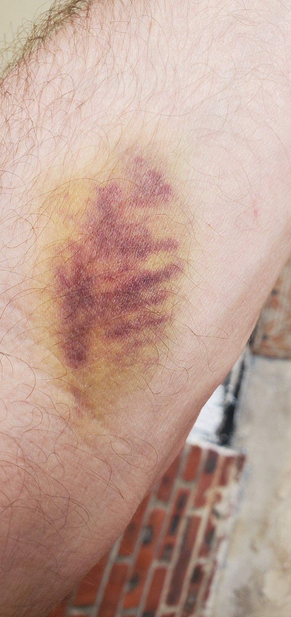 Oddly shaped purple-and-yellow bruise on my inner forearm near the elbow