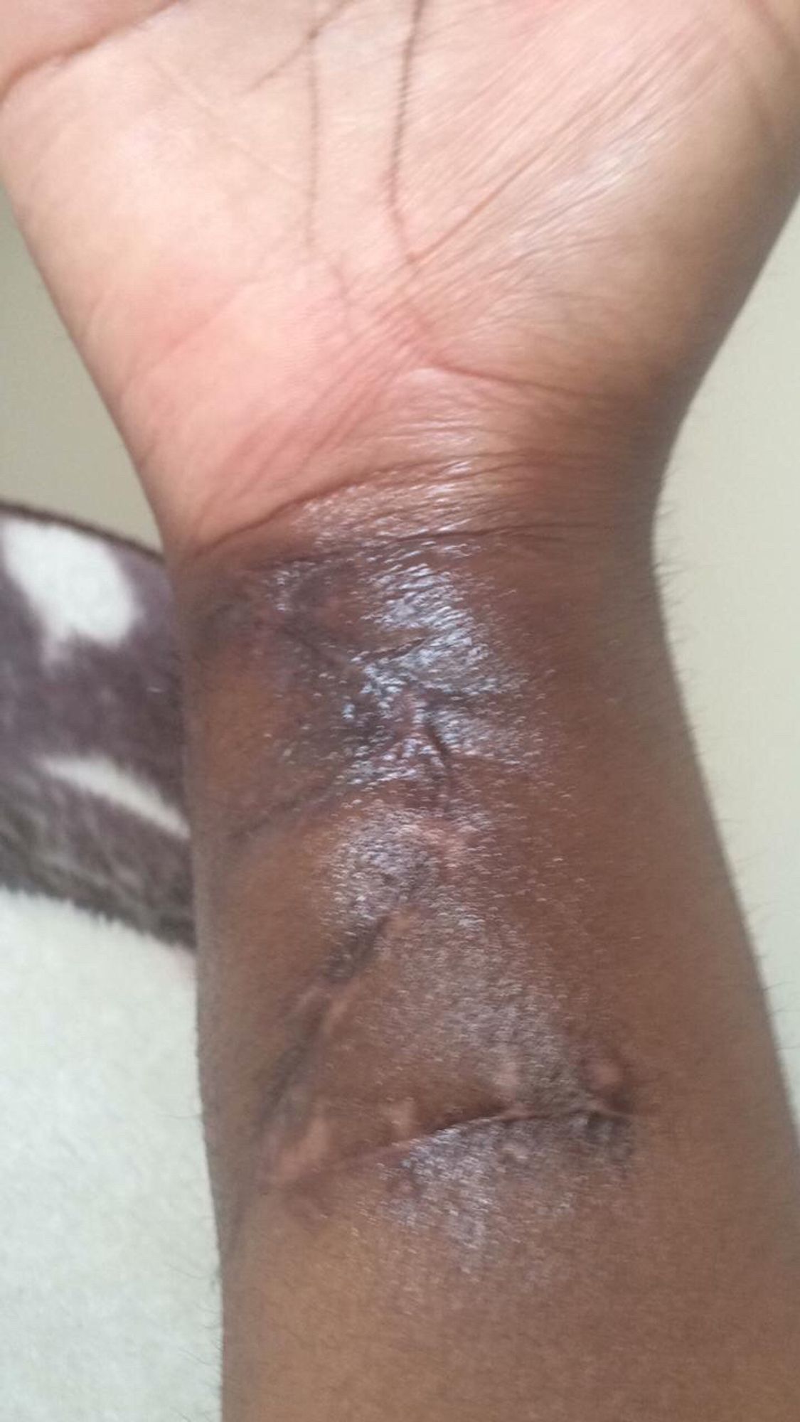 brown-skinned woman showing a z-shaped scar on the right forearm. the wound is still quite swollen