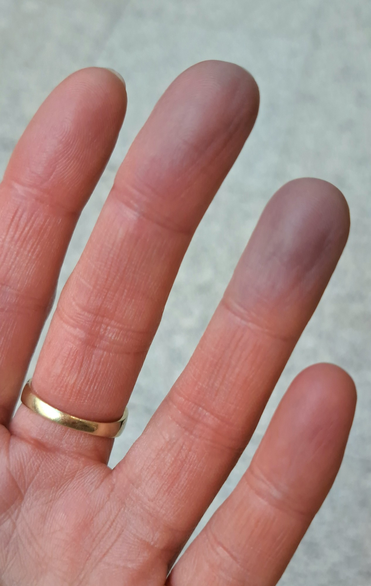 Blue fingers on white woman's hand - Raynaud's