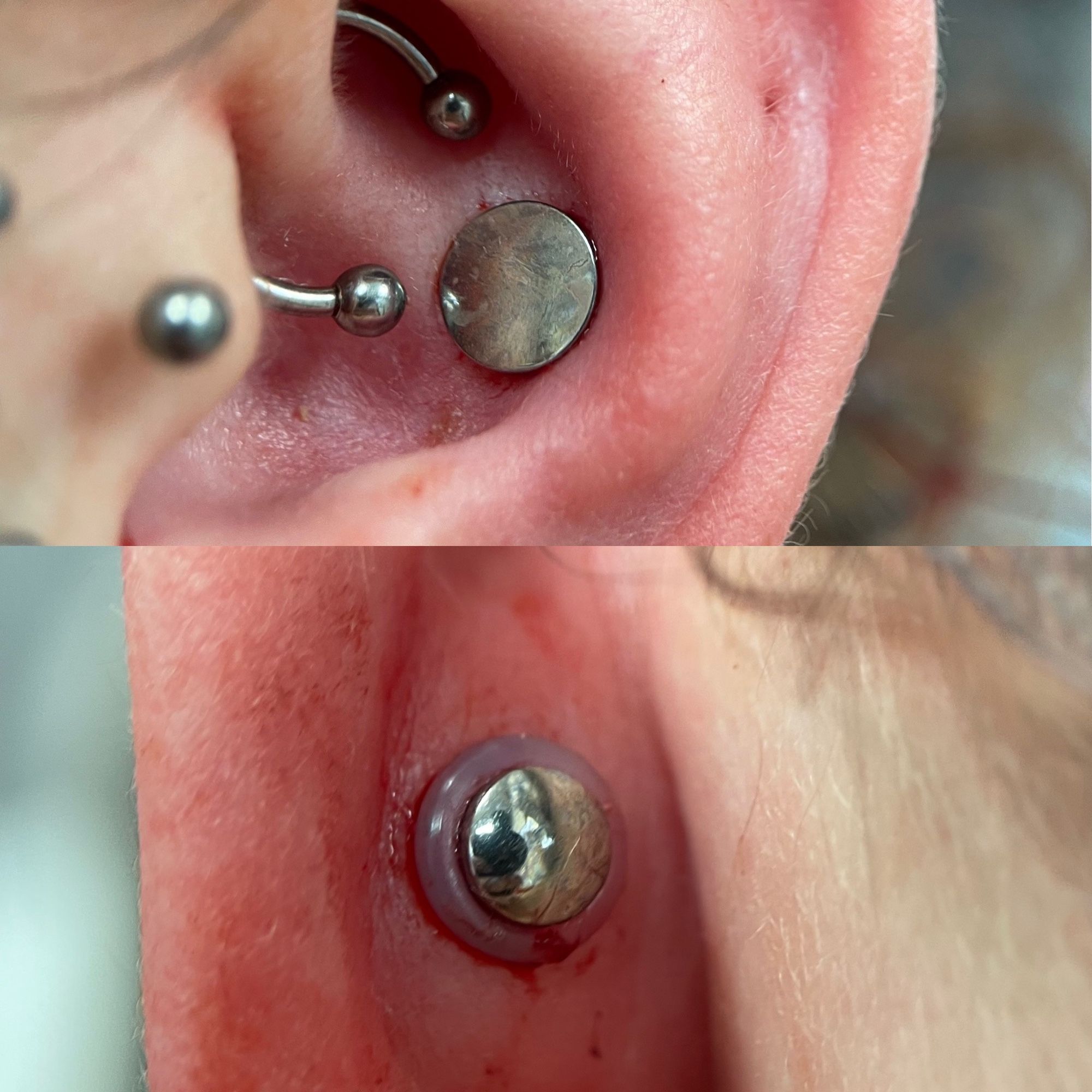 Photo d’un punch au conch (piercing dans le fond creux de l’oreille) en cinq millimètres, vu de l’avant et de l’arrière. Ici on a posé un plug en titane gris simple.