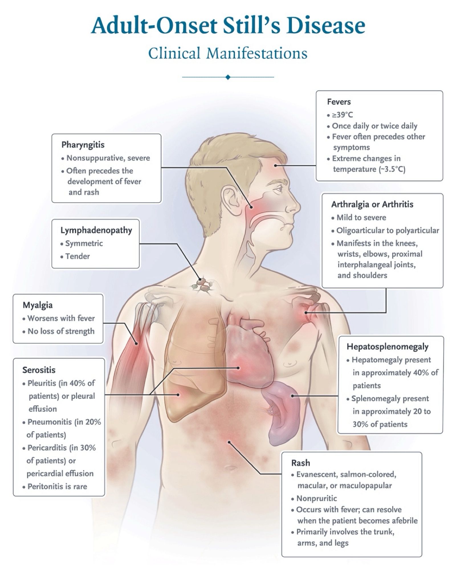 Adult-Onset Still's Disease
Clinical Manifestations