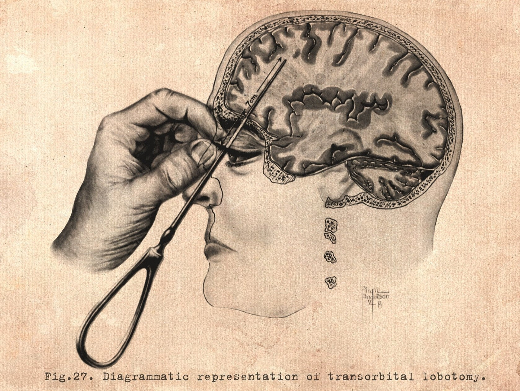 Lobotomy diagram, hand holding the eyelid to while the pick penetrant the brain