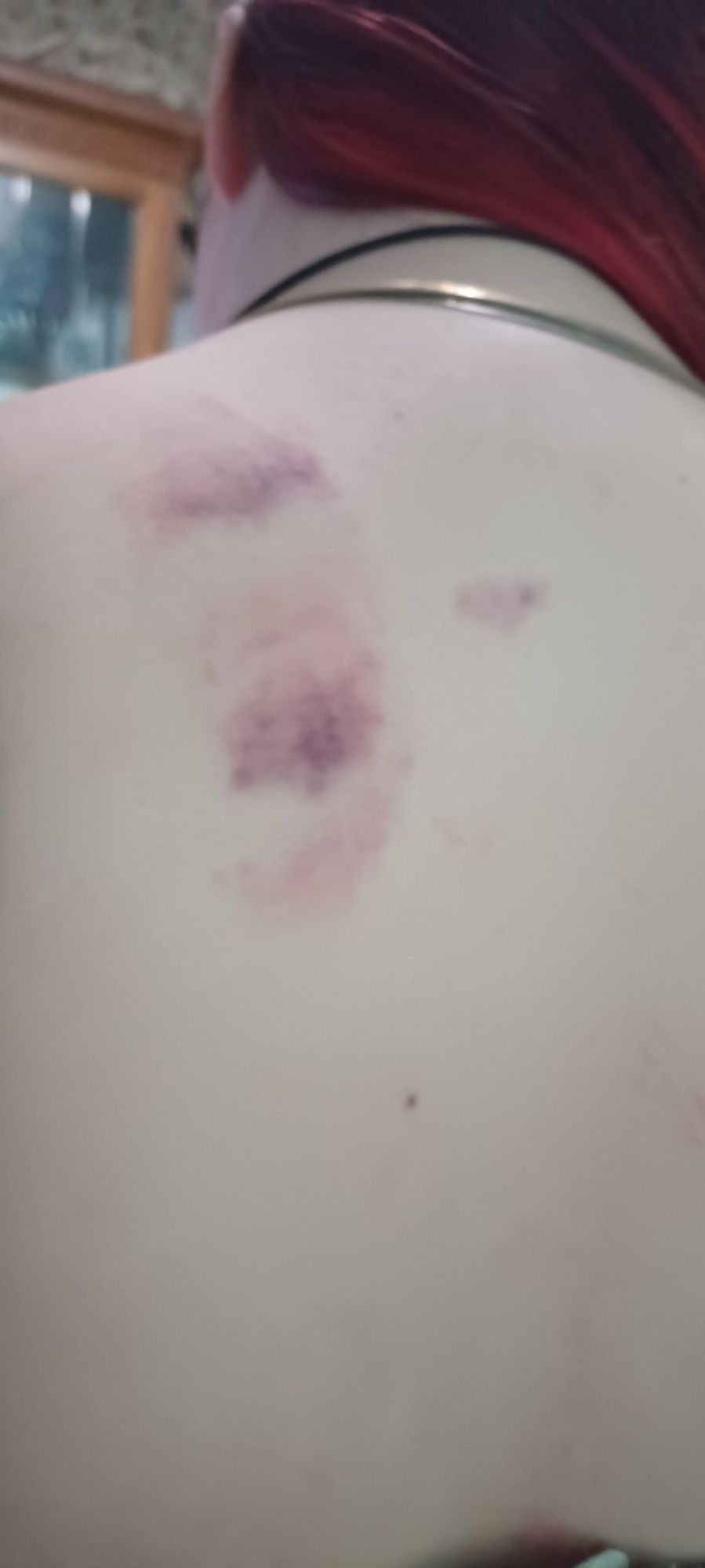 Bite marks