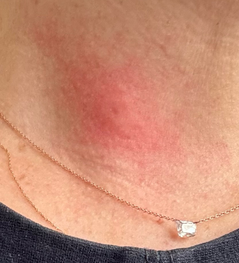 My neck with a red bee sting. Status of stinger presently unknown.