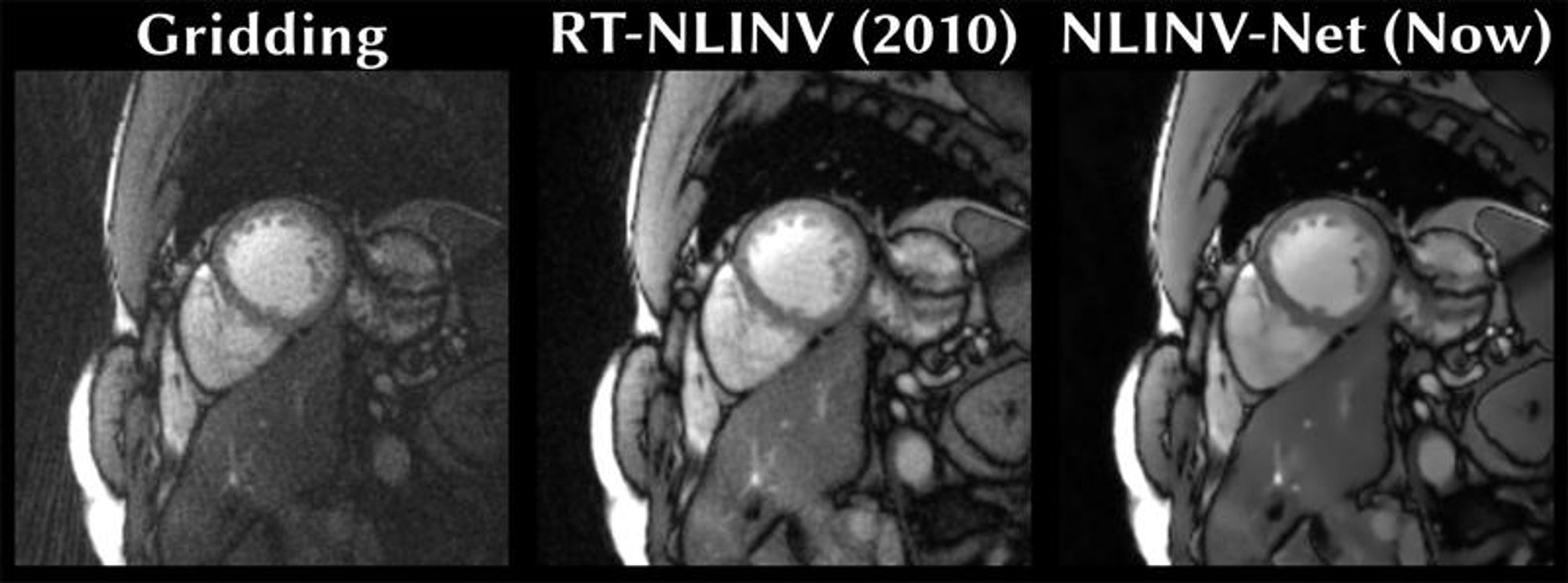 Short-axis section through the heart: The simple MRI image reconstruction method “Gridding” (left), “RT-NLINV” method developed in 2010 (center) and the new “NLINV-Net” method (right), combining the modeling of RT-NLINV with machine learning. - Copyright TU Graz - Institute of Biomedical Imaging