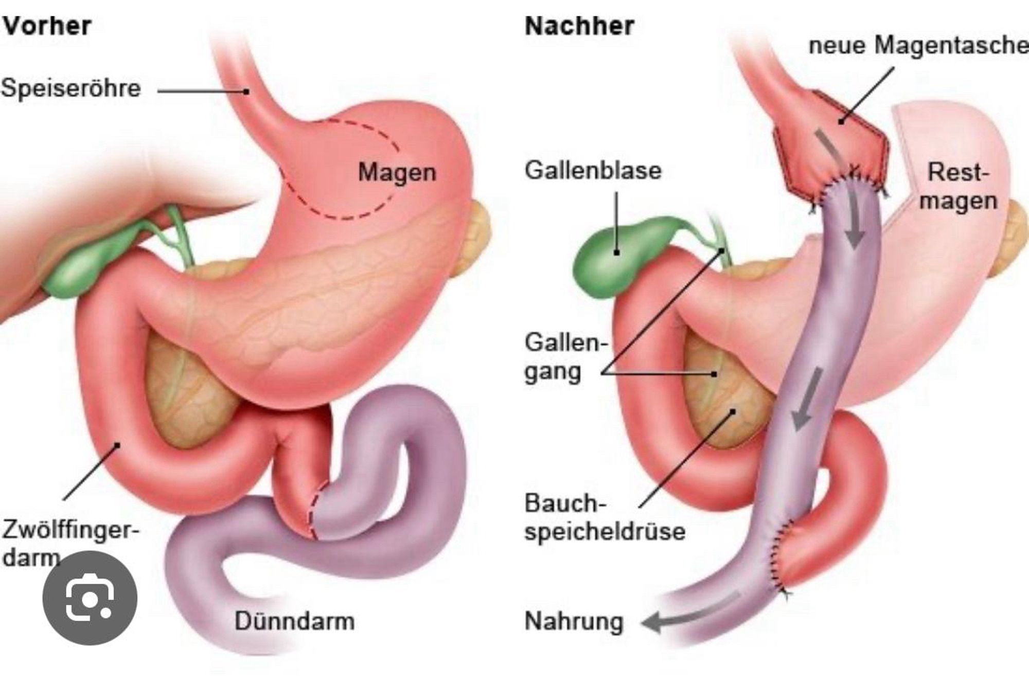 Bildhafte anatomische Darstellung eines normalen Magens mit Speiseröjre, Zwölffingerdarm, Dünndarm -links- 
Und nach Magenbypass-OP mit Magentasche und neuer Verbindung direkt zum Dünndarm. Der Restmagen verbleibt im Bauch mit Verbindung zur Bauchspeicheldrüse und Dünndarmschlinge, die weiter unten auf den restlichen Dünndarm trifft. Der Mageninhalt der kleinen neuen Magentasche rutscht über die neue Verbindung direkt in den Dünndarm und trifft erst sehr viel später auf die Verdauungssäfre aus Restmagen, Bauchspeicheldrüse etc. So wird nicht nur erheblich weniger Nahrung aufgenommen, dieses Verfahren enthält auch ein malabsorbtives Element, dh die Nährstoffe werden viel viel schlechter aufgenommen. Dadurch erfolgt die Gewichtsabnahme.