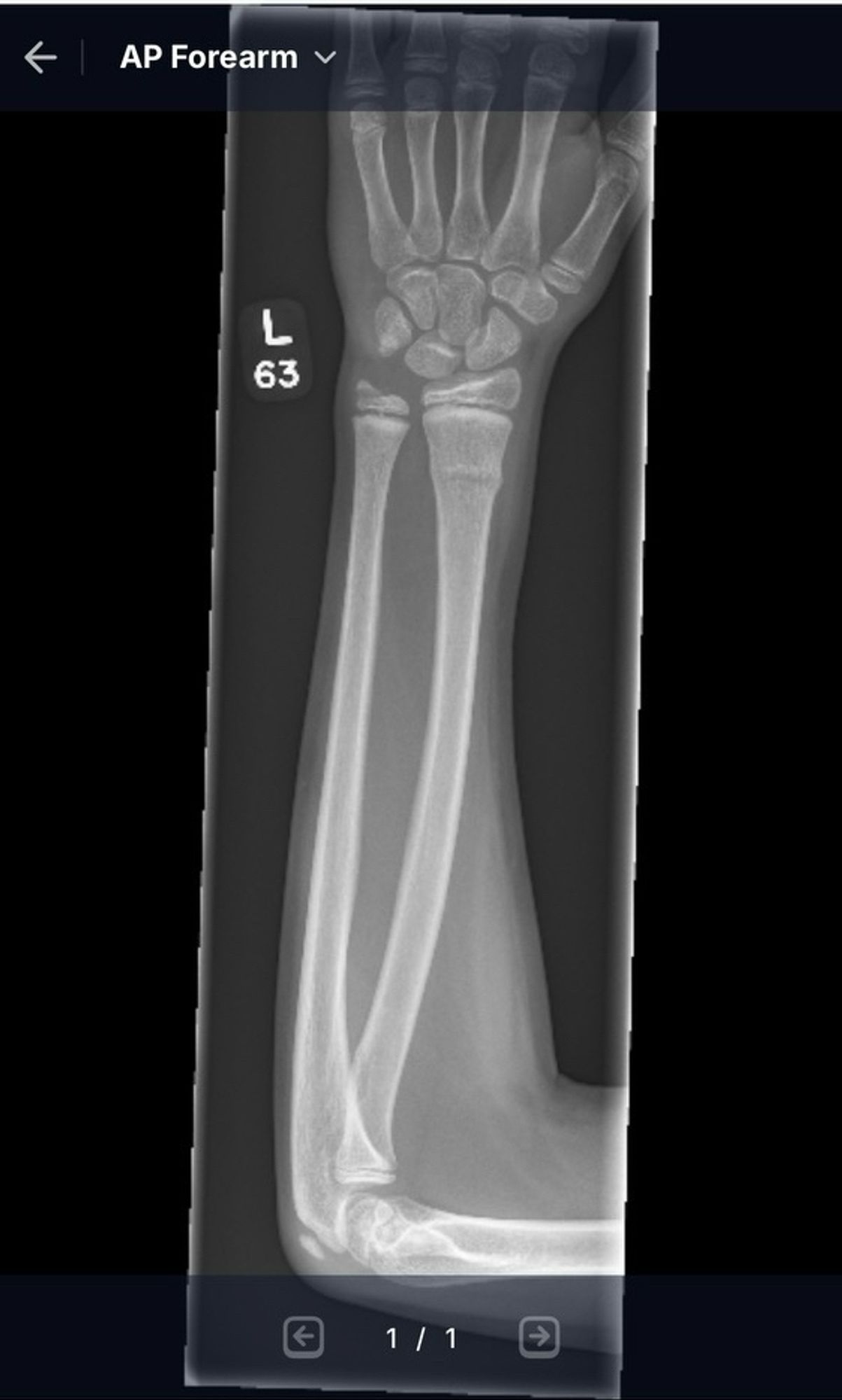 Forearm X-ray showing a radial buckle fracture and for the eagle eyed, an ulnar styloid fracture. 