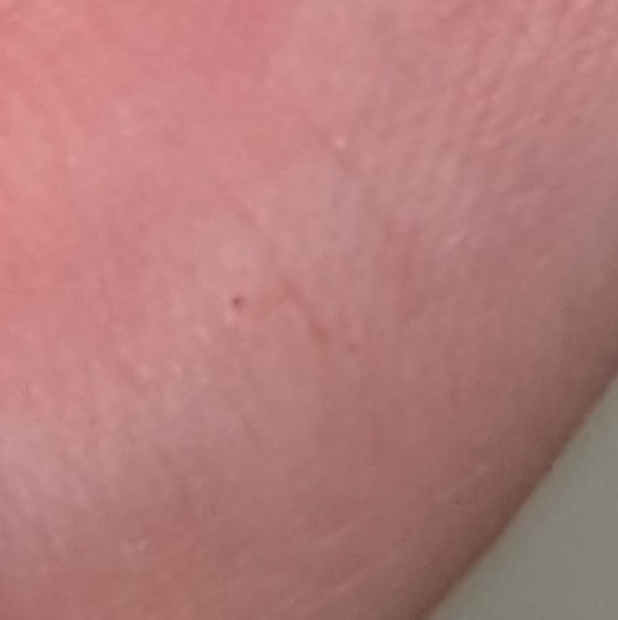 Close up image of my left middle finger, showing the base of the distal phalanx. Two tiny dots can be seen, showing where the spider bit me. Maybe??