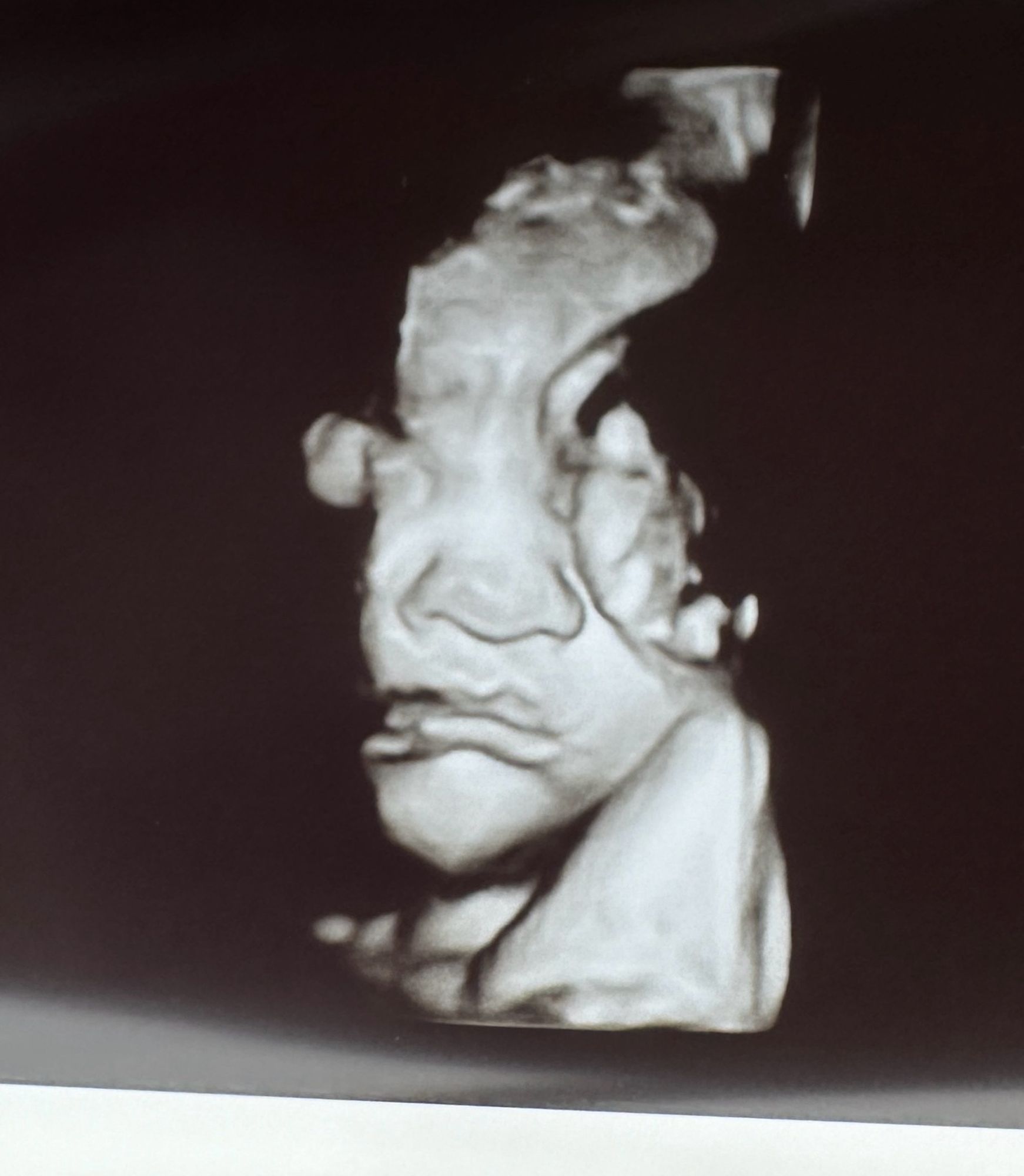 Ultrasound pic of the middle of a baby face. Concerned/pouty eyebrows and lips