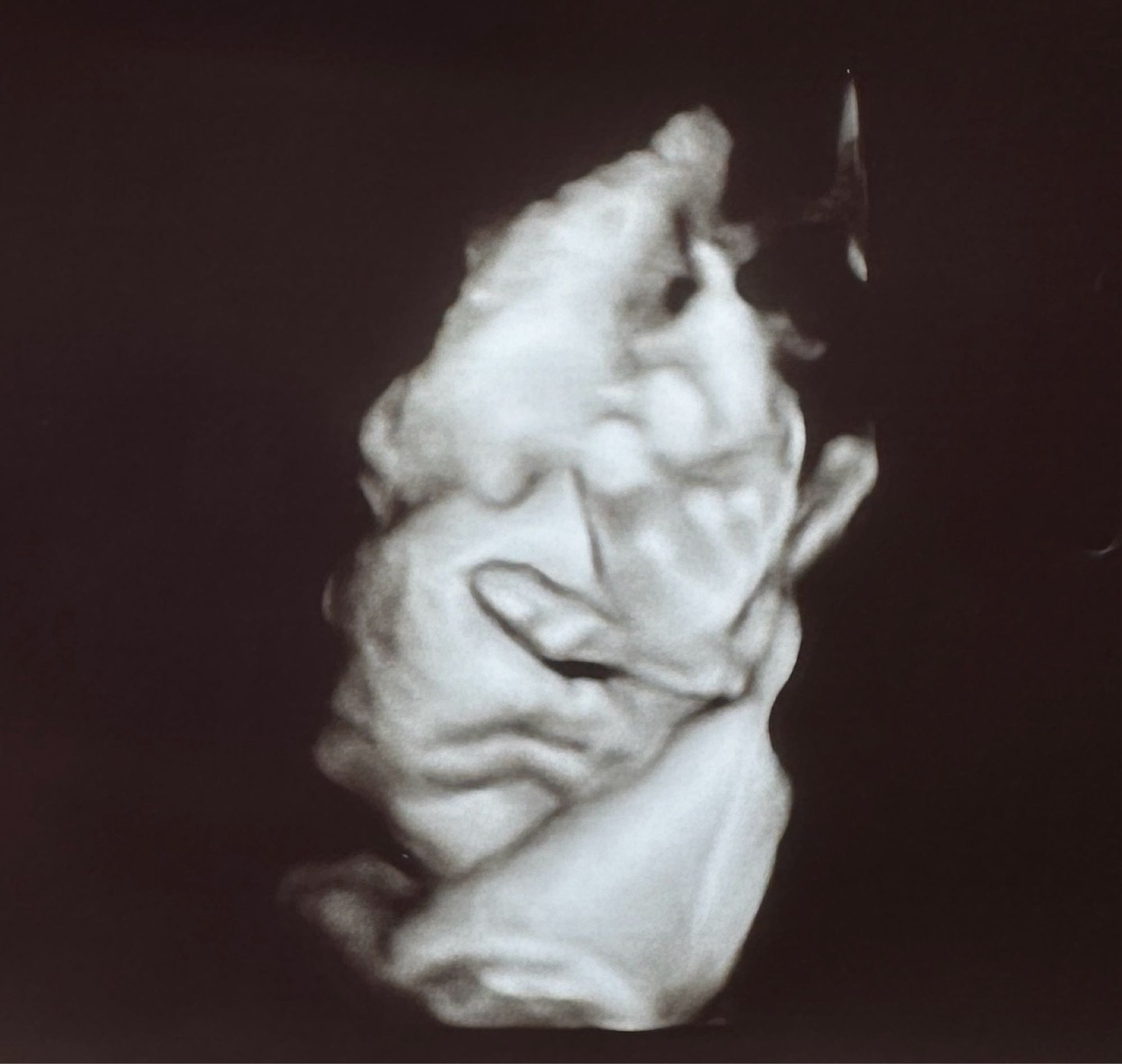 Ultrasound pic of baby covering half his face with his hand