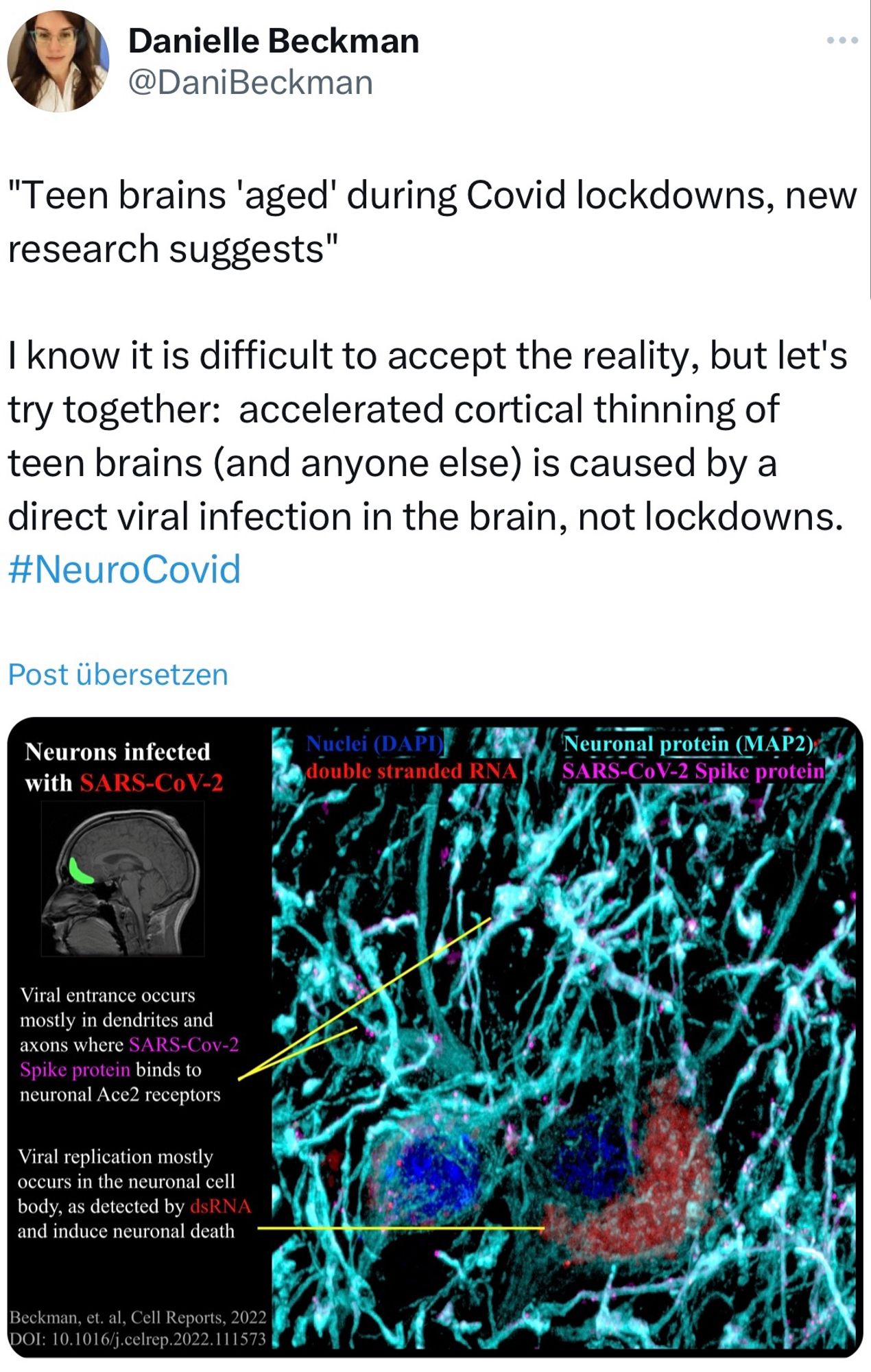 Post von Danielle Beckman
@DaniBeckman auf X vom 27.09.24 22:28 Uhr
"Teen brains 'aged' during Covid lockdowns, new research suggests"
I know it is difficult to accept the reality, but let's try together: accelerated cortical thinning of teen brains (and anyone else) is caused by a direct viral infection in the brain, not lockdowns.
#NeuroCovid
Post übersetzen
Neurons infected with SARS-CoV-2
Nuclei (DAPD}

Neurons infected with SARS-CoV-2
Nuclei (DAPI)
double stranded RNA
Neuronal protein (MAP2),
SARS-CoV-2 Spike protein
Viral entrance occurs mostly in dendrites and axons where SARS-Cov-2
Spike protein binds to neuronal Ace2 receptors
Viral replication mostly occurs in the neuronal cell body, as detected by dRNA and induce neuronal death
Beckman, et. al, Cell Reports, 2022
DOI: 10.1016/j.celrep.2022.111573