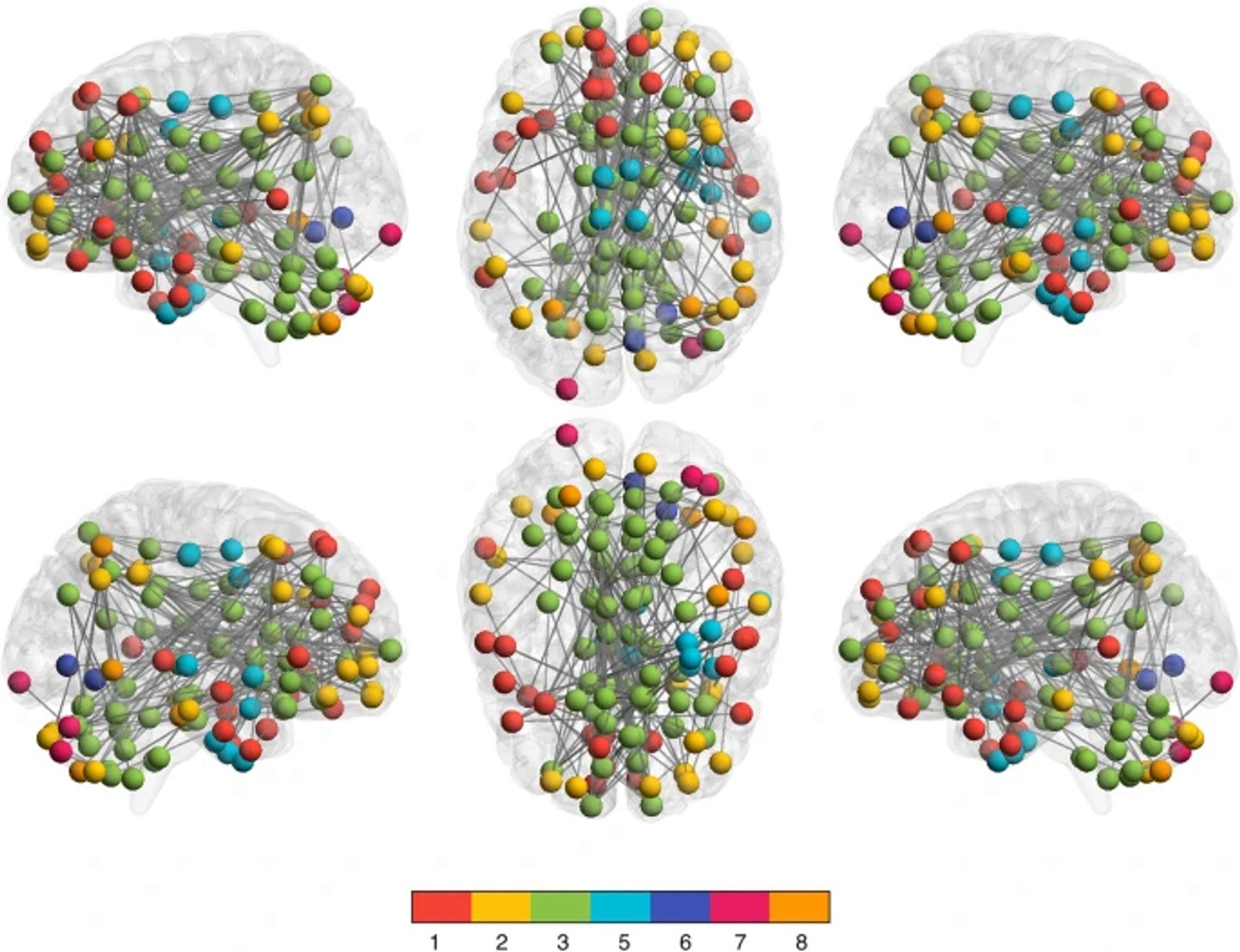 Hypo-connected functional connectome edges. Network-based statistic (NBS) analysis indicated that the COVID-19 group demonstrated significantly lower functional connectivity compared to controls in multiple cortical and subcortical regions across the entire brain, especially the default mode network (mean t = 3.47 ± 0.36, range = 3.1–5.14, p = 0.033, FWE corrected, d = 0.92 to 1.5). The functional connectome is shown here as a graph with spheres representing nodes (regions) and lines representing their functional connections (edges). Nodes are colored by their membership in 1 of 8 functional networks evaluated (see color bar): 1: medial frontal, 2: frontoparietal, 3: default mode, 4: subcortical/cerebellar, 5: motor, 6: visual 1, 7: visual 2, 8: visual association (there were no significant differences in network 4). There were no regions of significant hyper-connectivity.