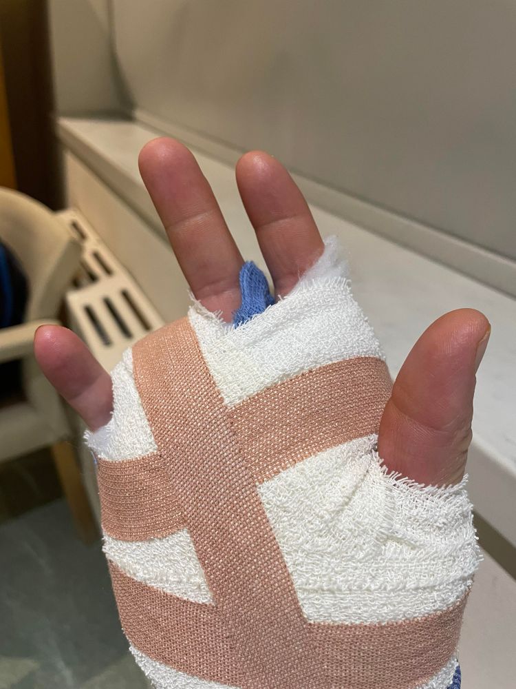A bandaged hand missing a finger 