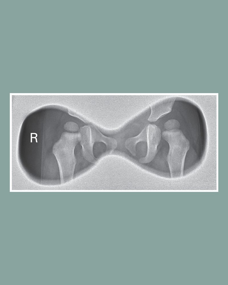 Anteroposterior radiograph of the pelvis at one year. The left hip is normal. The right hip has a smaller ossific nucleus of the femoral head, lateralization of the femoral head (borderline International Hip Dysplasia Institute grade 1 or 2), and a higher acetabular index than the left side.