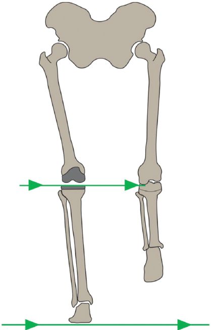 Postoperative tibial joint line is parallel to the plane of the floor during the single-leg stance phase of gait.