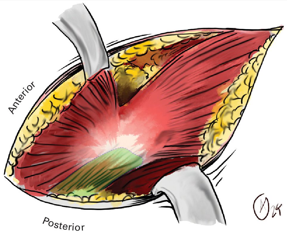 The gluteus medius can be considered both anatomically and functionally as two separate muscles. The posterior portion is highlighted in green, and functionally these muscle fibres act as a lateral stabilizer of the hip.
