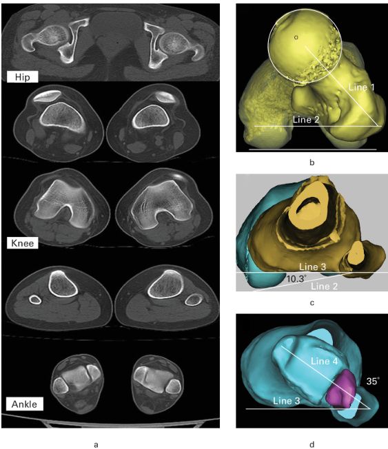 a) Illustration of routine lower limb hip-knee-ankle CT scans and the measurement of knee torsion. b) Measurement of the femoral anteversion angle (FAA). 
