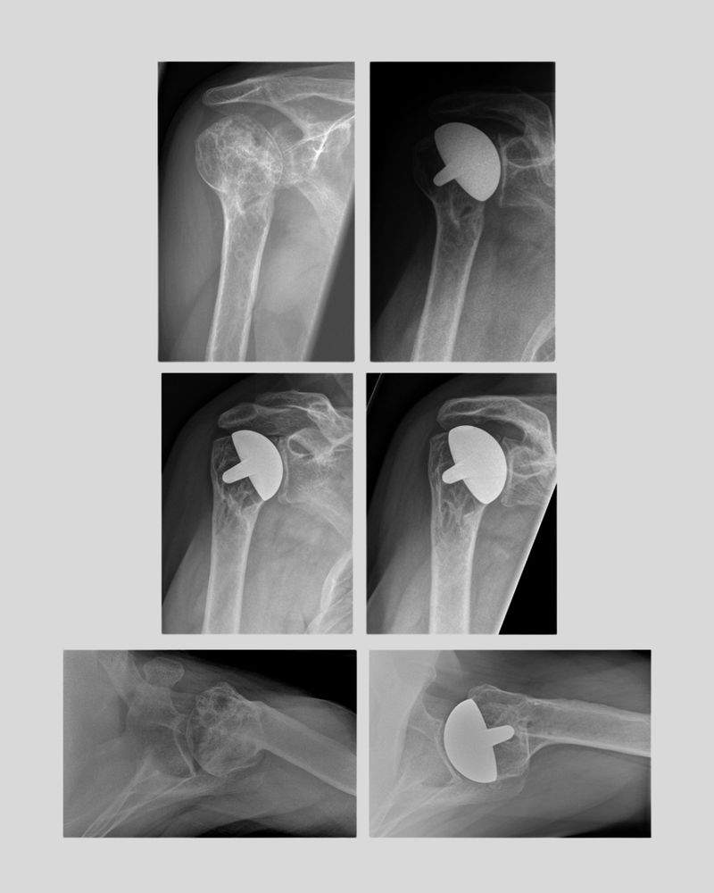 Postoperative radiological course after stemless humeral head arthroplasty. 
The Bone & Joint Journal.