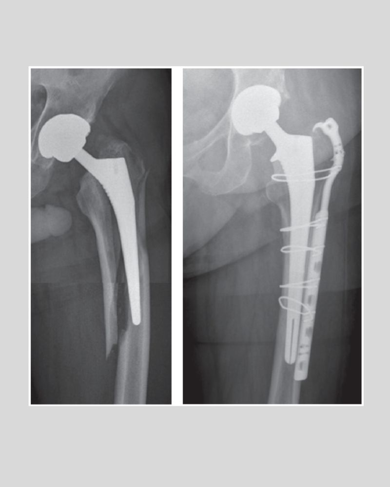 An example of a Vancouver B2 periprosthetic fracture on an anteroposterior radiograph in a 75-year-old female sustained a) one month postoperatively in a patient in the collarless group, and b) after revision.