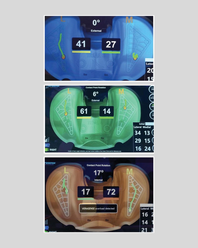 Examples of each kinematic pattern. a) Medial pivot. b) Symmetrical rollback. c) Lateral pivot.
