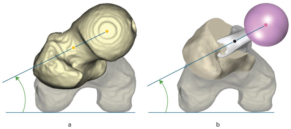 a) Native femoral anteversion and b) component anteversion were defined as the angle between the axis joining the centre of the femoral head and neck and the posterior condylar axis, measured in the plane perpendicular to the long axis of the femur (defined as the axis from the midpoint of the medial and lateral condyles and the piriformis fossa).