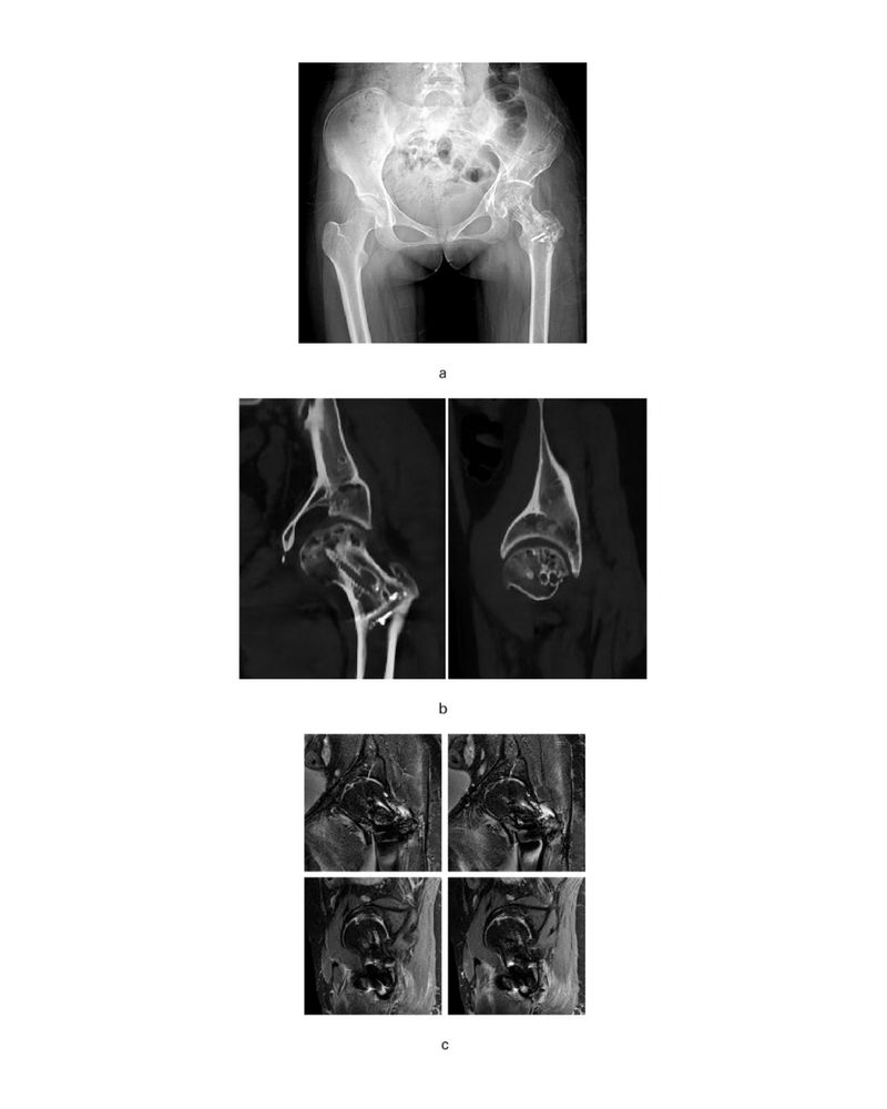 Images at 35.0 months of postoperative follow-up of the case in Supplementary Figure a. a) Anteroposterior radiograph of the pelvis. b) Coronal and sagittal CT scans. c) Coronal and sagittal MRI. The femoral head shows mild signs of arthritis but uniform density, with signs of repair in the necrotic area and no collapse occurring.