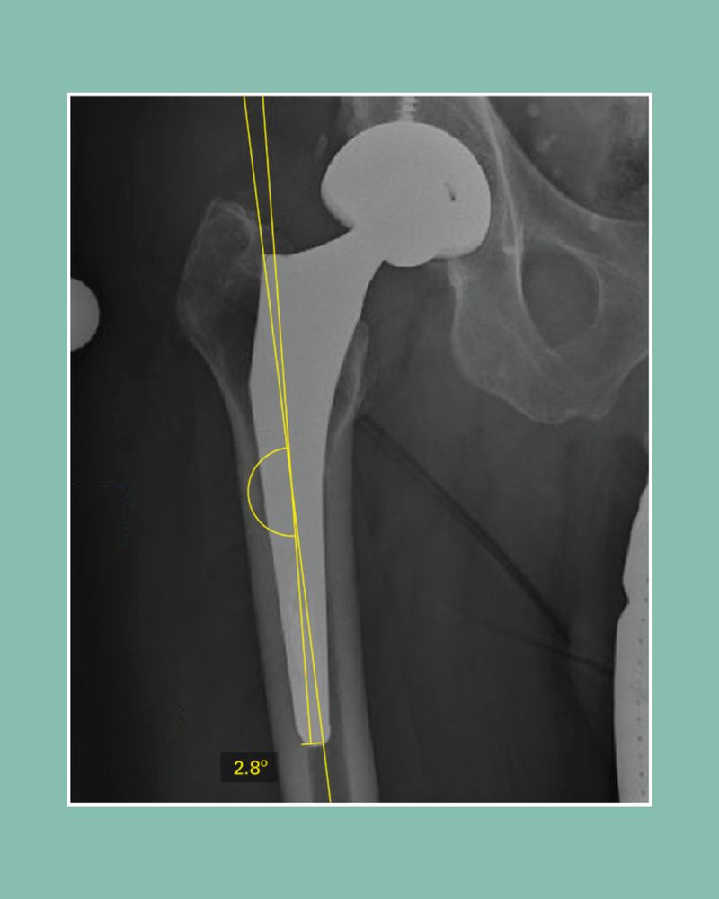 Measurement of the coronal alignment of the femoral component on the anteroposterior radiograph.